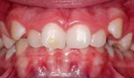 Closeup of crooked teeth before orthodontics