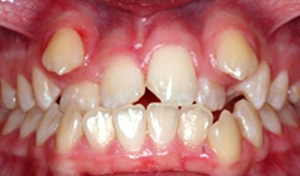 Closuep of smile with severely misaligned teeth