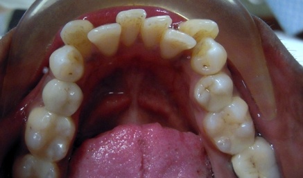 Closeup of bottom teeth with severe misalignment