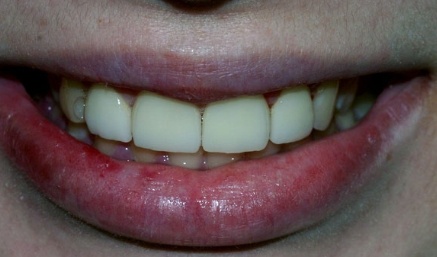 Smile after gaps between top teeth are closed