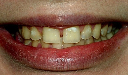 Smile with large gaps between top teeth