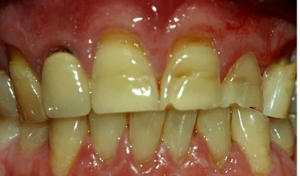 Closeup of severely decayed and damaged smile before cosmetic dentistry