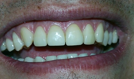 Smile after top front teeth are repaired