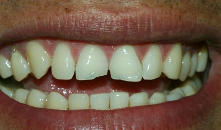 Smile with chipped top front teeth