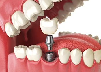 A 3D illustration of the parts of a dental implant
