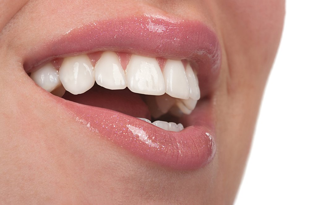 Close up of woman’s teeth with veneers