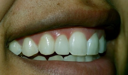 Smile after top tooth is built up to the same size as a regular tooth