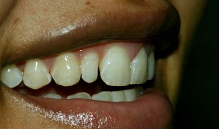 Smile with smaller top tooth