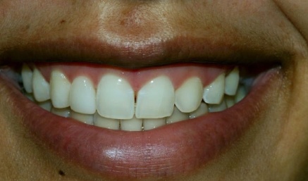 Smile after teeth are evenly spaced
