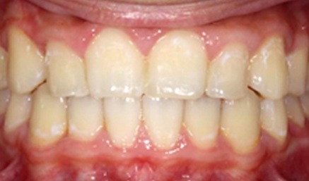Aligned smile after orthodontics