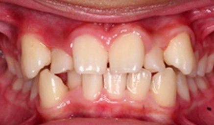 Crooked teeth before orthodontics