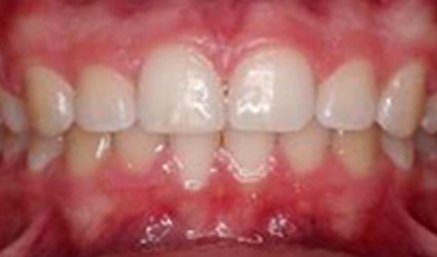 Closeup of aligned smile after orthodontics