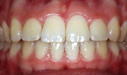 Closeup of smile after teeth are aligned