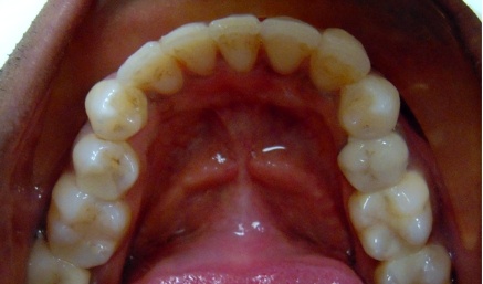 Closeup of bottom teeth after alignment is corrected
