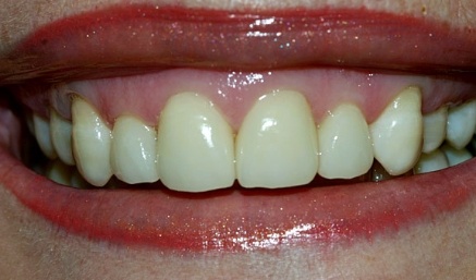 Smile with healthy aligned teeth