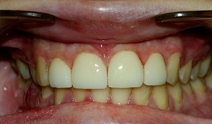 Closeup of smile after gaps between top front teeth are closed