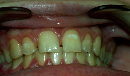 Closeup of smile with large gaps between top front teeth
