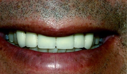 Closeup of flawless healthy smile after cosmetic dentistry