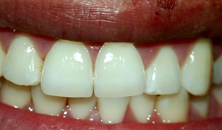 Smile with repaired top front tooth