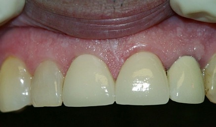 Smile after damaged and decayed top front teeth are repaired