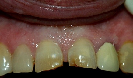 Smile with damaged and decayed top front teeth