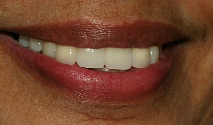 Aligned healthy smile after dental treatment