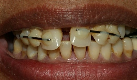 Misaligned smile during dental treatment
