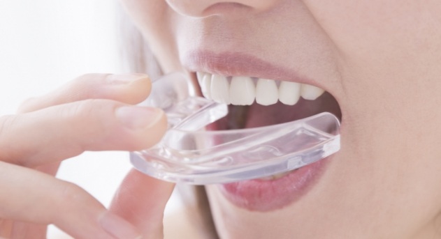 Closeup of person placing a nightguard for bruxism