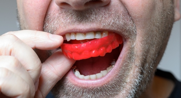 Closeup of patient placing an athletic mouthguard