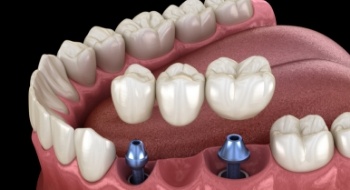 Animated smile during dental implant supported fixed bridge placement